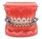 Dental model showing teeth with metal braces and springs, demonstrating orthodontic alignment. The gums appear pink, providing a realistic anatomical display.